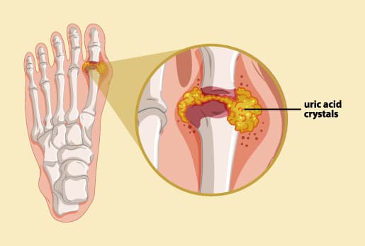 What Are My Odds Of Getting Gout?