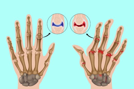 Am I At The Risk Of Rheumatoid Arthritis?