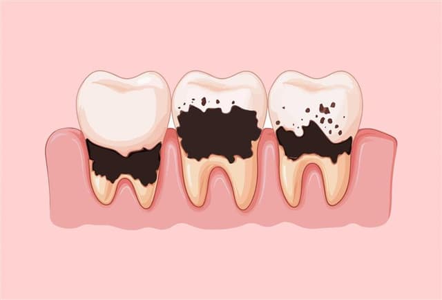 Are My Teeth Safe From Decay?