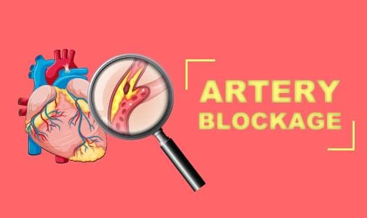Artery blockage- Symptoms & Diagnosis