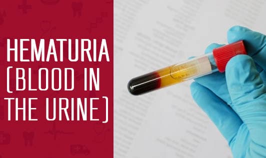 Hematuria (Blood in the Urine): Prevention & Treatment