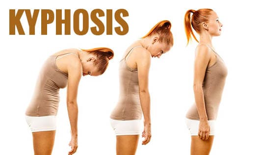 Is Kyphosis (Roundback Bending) Of The Spine Treatable?