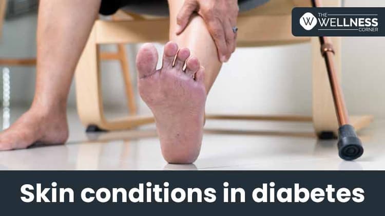 Skin conditions in diabetes