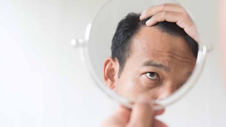 Male Pattern Baldness: Causes, Symptoms, and Prevention