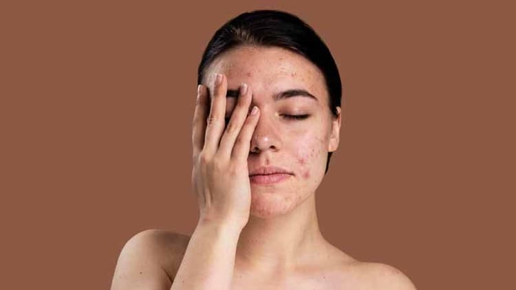 Effective Ways To Treat Scars (Surgical + Natural)