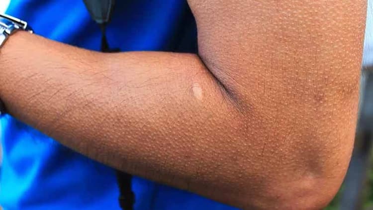 Why Do We Get Goosebumps?
