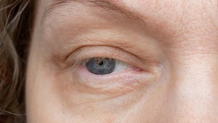 Drooping Eyelid (Ptosis): Causes, Symptoms, and Treatment