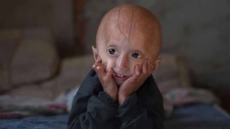 Why My Child Looks Older Than Their Age? It Can Be Progeria