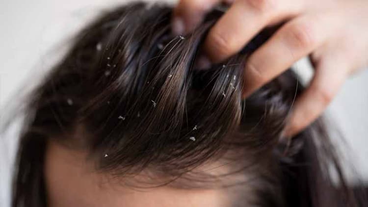 Winter Dandruff Treatment: Ways To Treat Scalp Issues