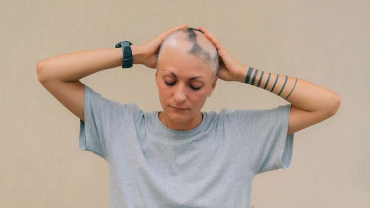 Chemotherapy And Hair Loss: What To Expect During Treatment?
