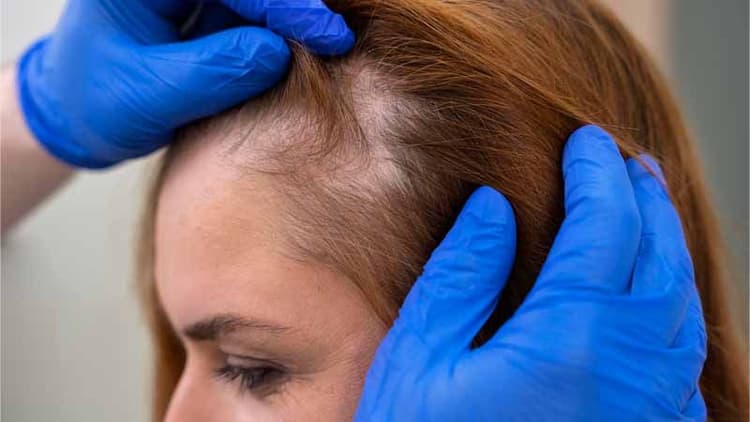 Losing Hair? Here’s Everything You Need to Know About Alopecia